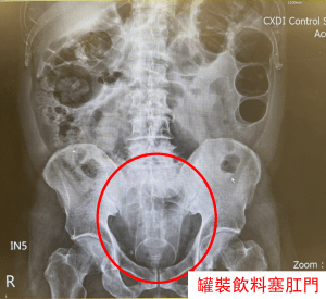 男子將13公分的易開罐飲料塞入肛門，5天候肚疼難耐就醫。