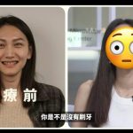 妙齡女整牙前後對比 網驚：巫婆變女神