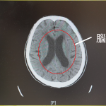 別再罵人「腦袋進水」水腦症三大症狀要注意